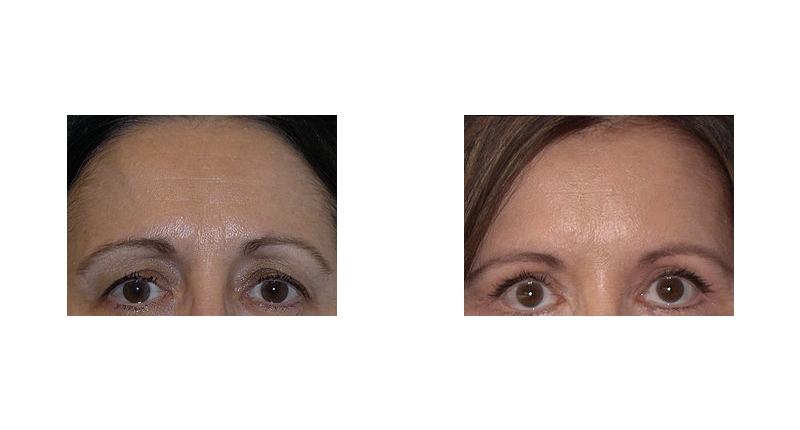 Brow Lift width='800