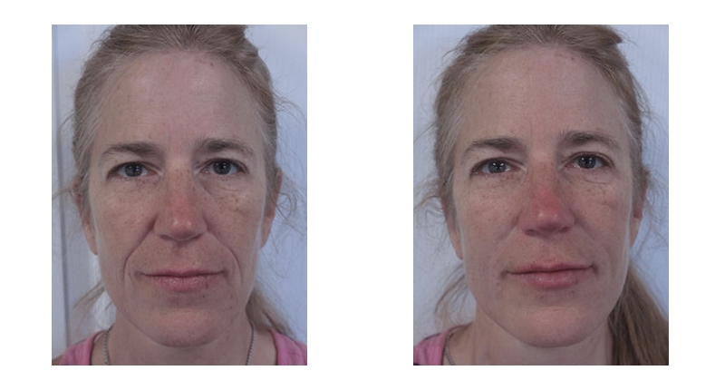 Dermal Fillers width='800