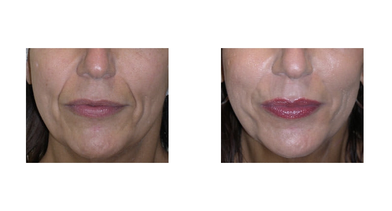 Dermal Fillers width='800