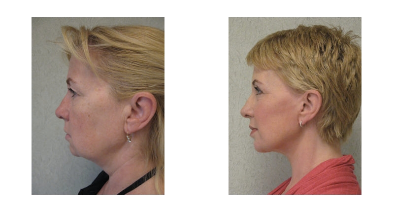 Face Lift width='800