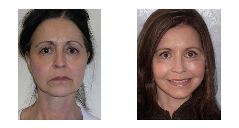 Face Lift width='800