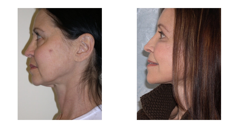 Face Lift width='800