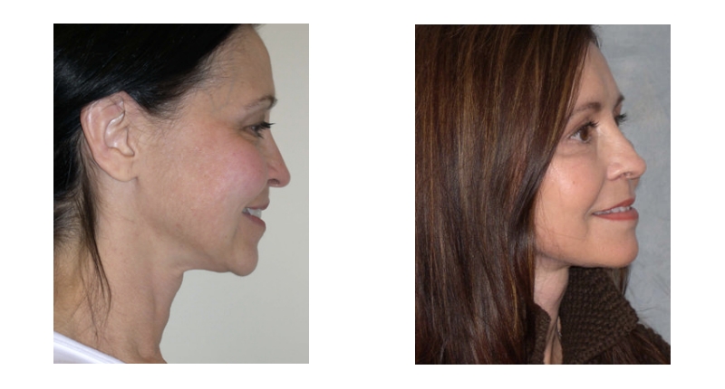 Face Lift width='800