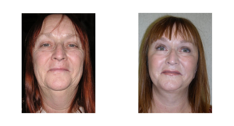 Face Lift width='800