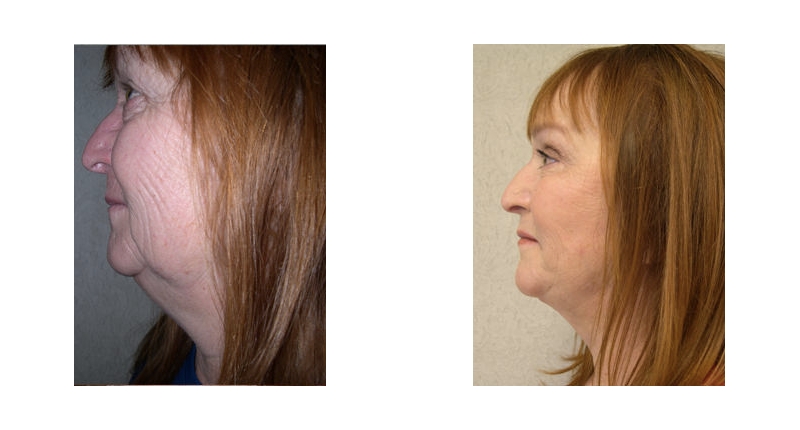 Face Lift width='800