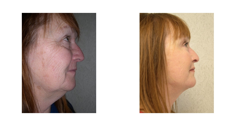 Face Lift width='800