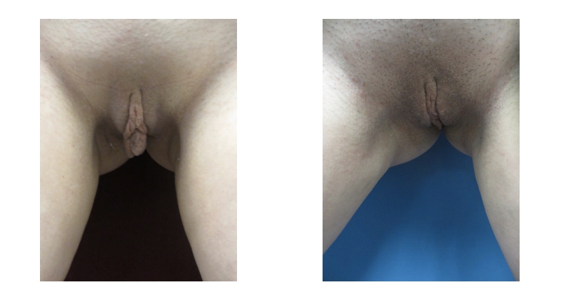 Labiaplasty width='800