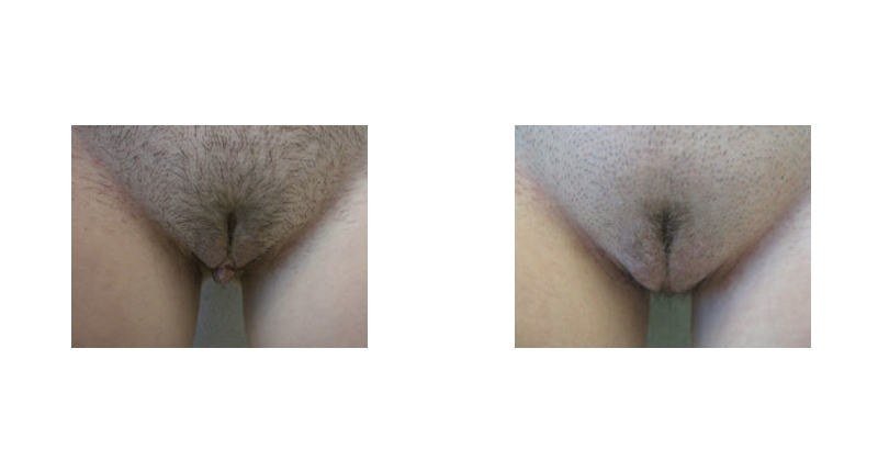 Labiaplasty width='800