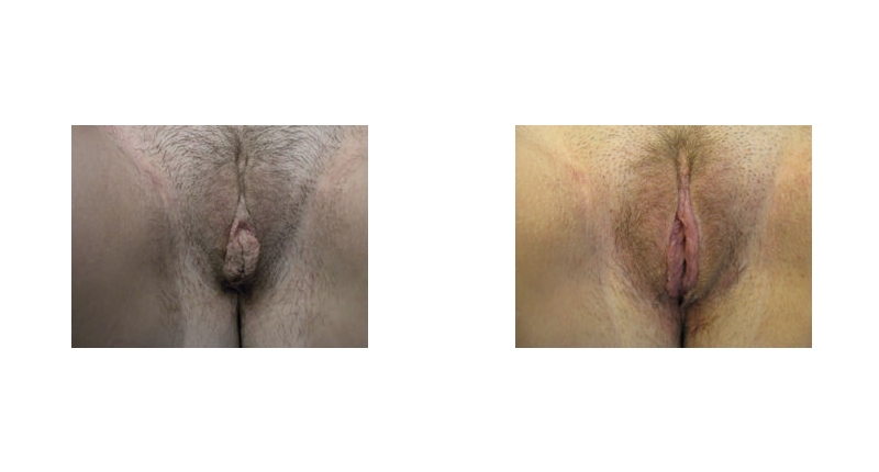 Labiaplasty width='800