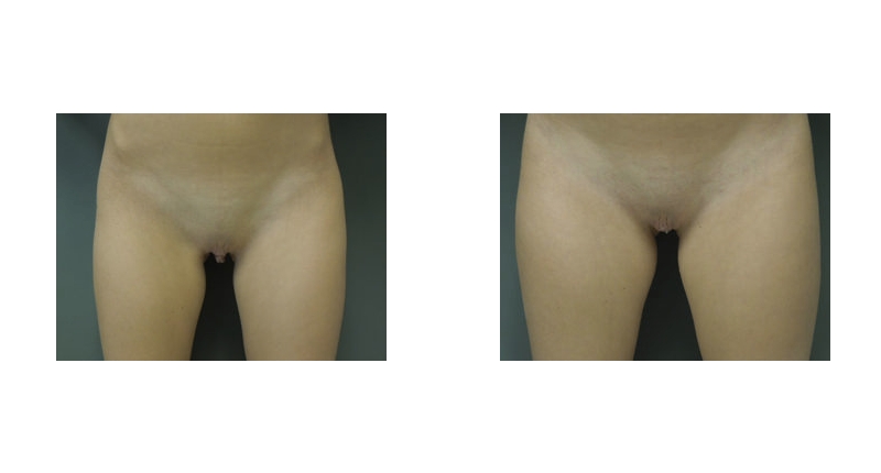 Labiaplasty width='800