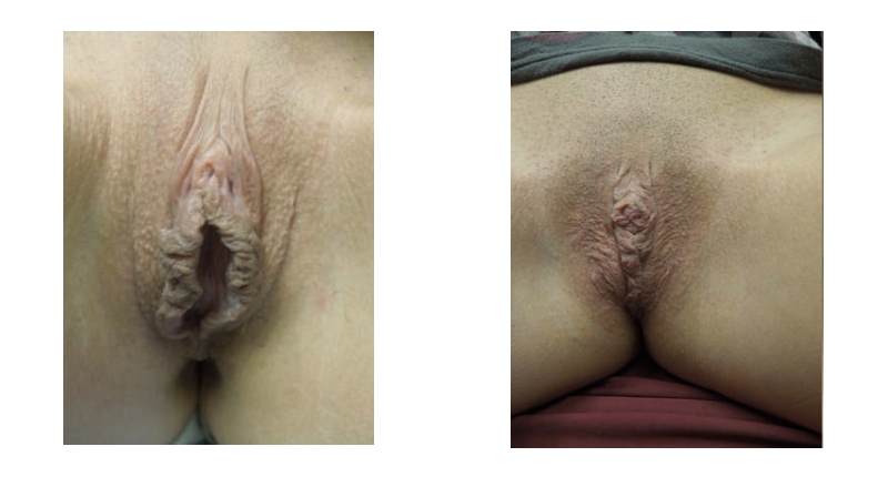 Labiaplasty width='800