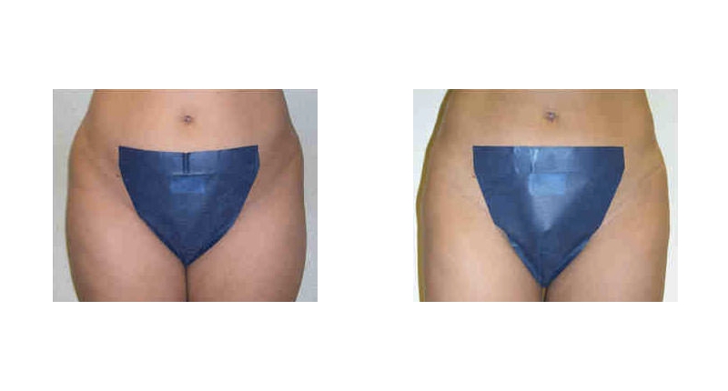 Liposuction width='800