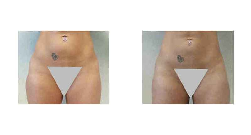 Liposuction width='800