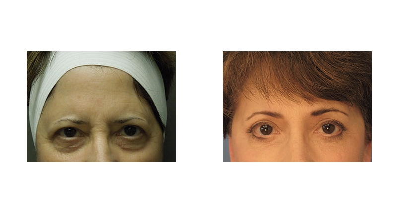 Quad Blepharoplasty width='800