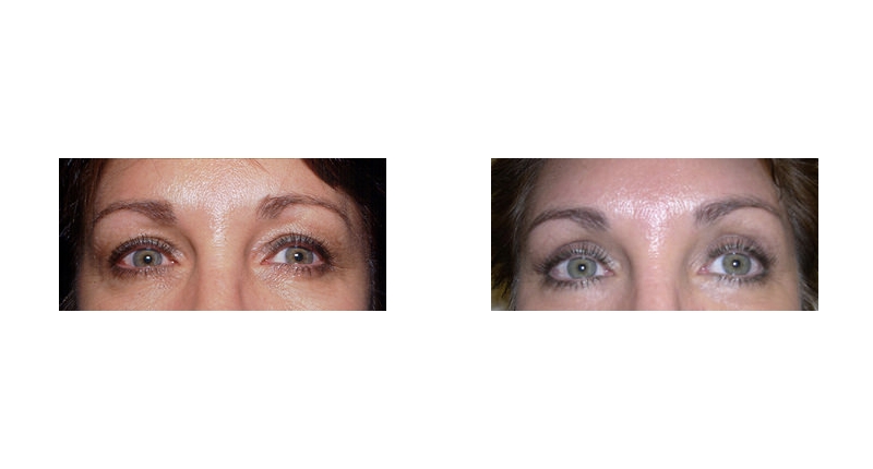 Quad Blepharoplasty width='800