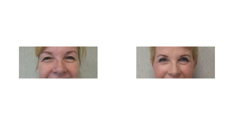 Quad Blepharoplasty width='800