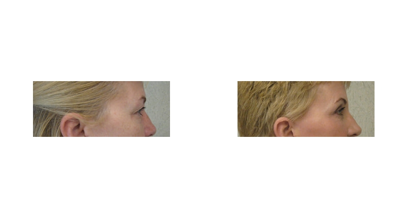 Quad Blepharoplasty width='800