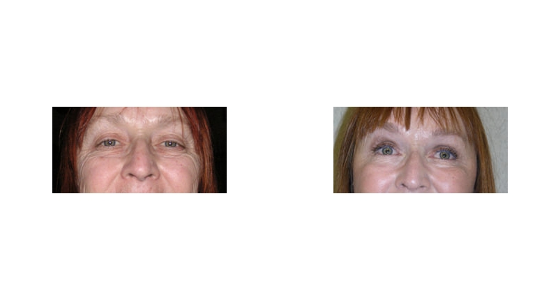 Quad Blepharoplasty width='800