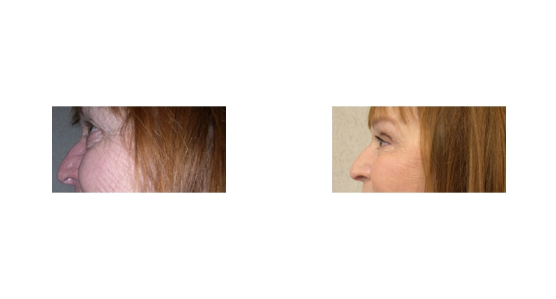 Quad Blepharoplasty width='800