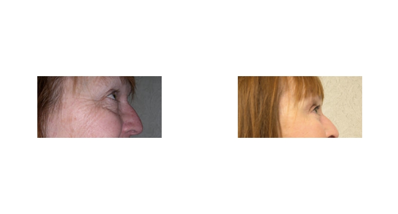 Quad Blepharoplasty width='800