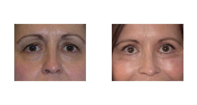 Quad Blepharoplasty width='800