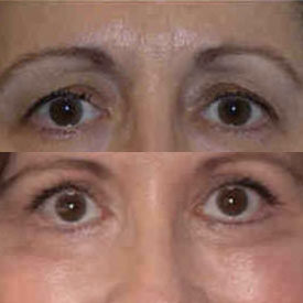 Quad Blepharoplasty