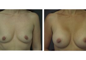 Breast Augmentation
