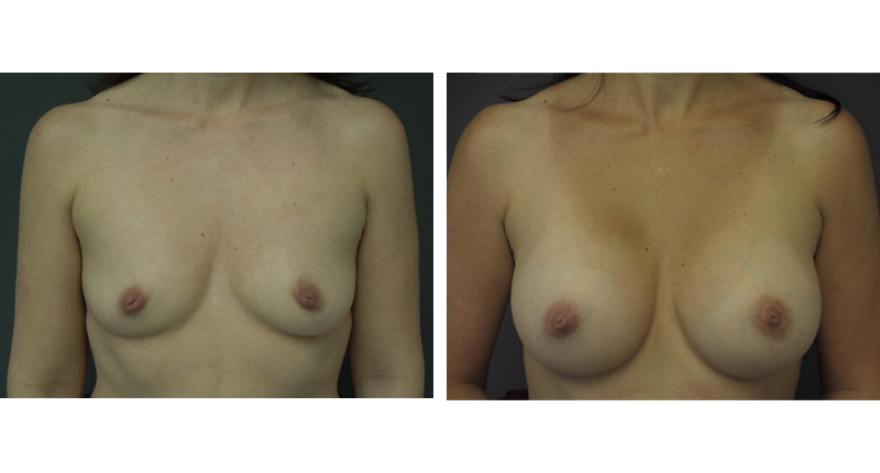 Breast Augmentation width='800