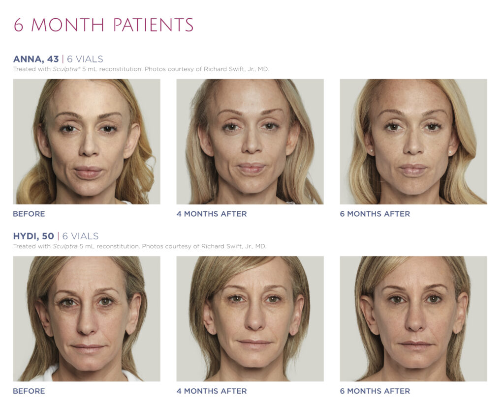 Sculptra Aesthetic In Denver Restore Facial Fullness