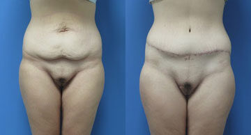 ch tummy tuck