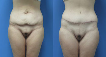 ch tummy tuck width='360