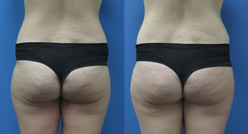 Abdominoplasty width='360