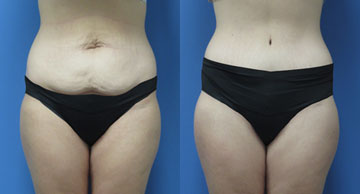 Abdominoplasty width='360