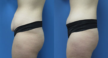 Abdominoplasty width='360