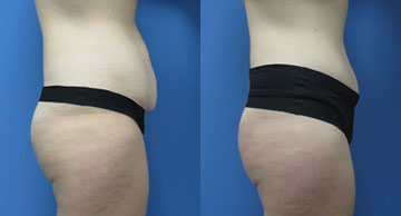 Abdominoplasty width='360