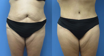 Abdominoplasty + Liposuction width='360