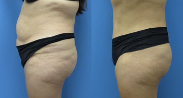 Abdominoplasty + Liposuction width='360