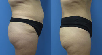 Abdominoplasty + Liposuction width='360