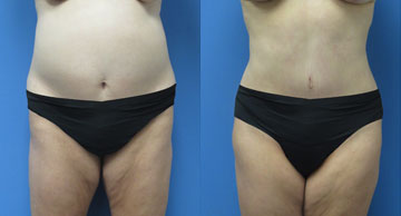 Abdominoplasty + Liposuction width='360