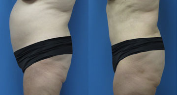 Abdominoplasty + Liposuction width='360