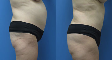 Abdominoplasty + Liposuction width='360