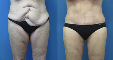 Abdominoplasty & Liposuction width='360