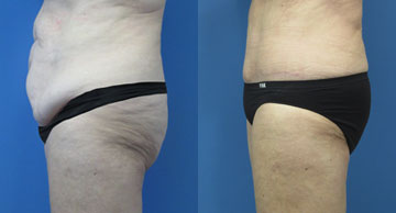 Abdominoplasty & Liposuction width='360