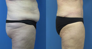 Abdominoplasty & Liposuction width='360