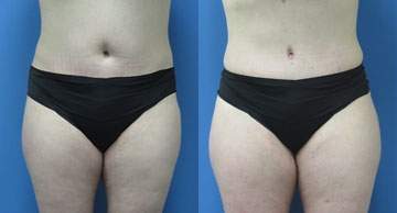 Abdominoplasty & Liposuction width='360