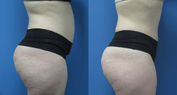 Abdominoplasty & Liposuction width='360