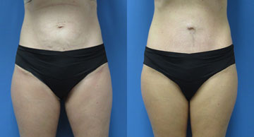 Abdominoplasty + Liposuction