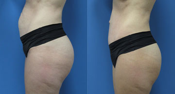 Abdominoplasty + Liposuction width='360