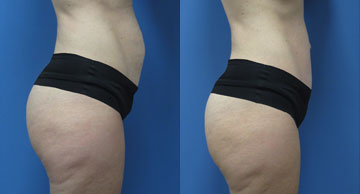 Abdominoplasty + Liposuction width='360