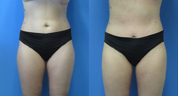 Abdominoplasty & Liposuction width='360